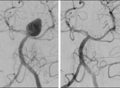 Angiographische Aufnahmen eines Aneurysmas der A. basilaris vor und nach „coiling“ mit 2 Stents (nicht sichtbar). 