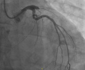 Bildgebung bei akutem Vorderwandinfarkt im Herzkatheterlabor