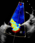 Hochgradige Mitralklappeninsuffizienz in der Echokardiographie (blau-gelb) vor der Katheter-Herzklappenbehandlung