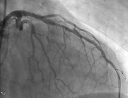 Bildgebung nach der Behandlung eines akuten Vorderwandinfarkts im Herzkatheterlabor