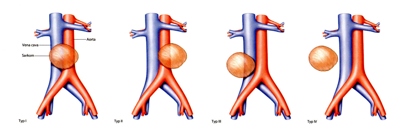 Blutgefäßbeteiligung am Beispiel der Bauchschlagader und der Hohlvene