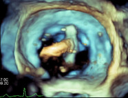 3D-Ultraschall mit Ausrichtung des MitraClip im linken Herzvorhof oberhalb der Mitralklappe