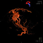 3D-Rekonstruktion einer arteriovenösen Malformation (AVM)