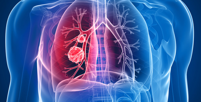 Transparenter Körper mit Lungentumor