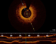 OCT-Bildgebung der Herzkranzgefäße im Herzkatheterlabor