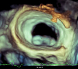 Echtzeit-3D Darstellung der Mitralklappe mittels Herzultraschall