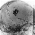 Röntgenbild einer arteriovenösen Malformation (AVM) nach Embolisation