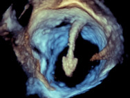 3D-Ultraschall mit Clip-System (PASCAL, Edwards Lifesciences) im linken Herzvorhof während des Herzklappeneingriffs