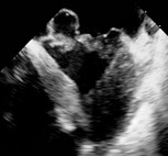 Mitralklappeninsuffizienz durch Mitralklappen-Sehnenfadenabriss (Herzultraschall)