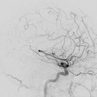 Angiographie einer arteriovenösen Malformation (AVM) nach Embolisation